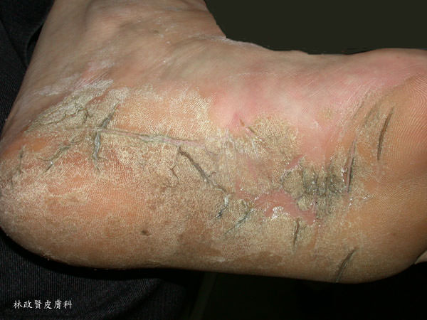 足癬,香港腳,黴菌感染,汗皰疹,皮癬菌,發黴,發霉,