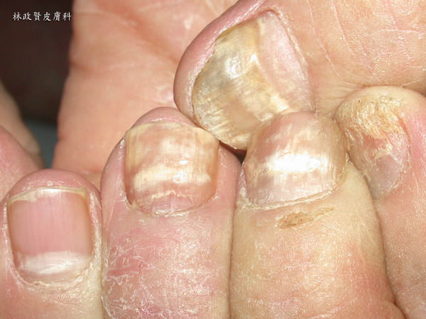 甲床剝離不是灰指甲 高雄皮膚專科林政賢醫師