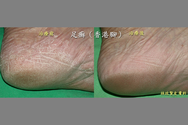 還在磨腳皮 小心可能是香港腳