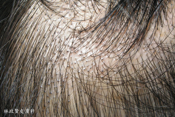 頭癬,髮癬,皮癬菌,黴菌感染,頭皮癢,斷髮,小黑點