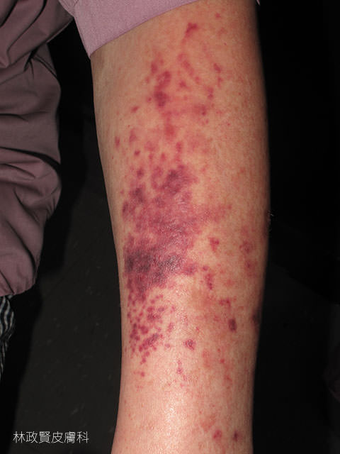 老年性紫瘢症,老年性紫斑症,senile purpura,active purpura