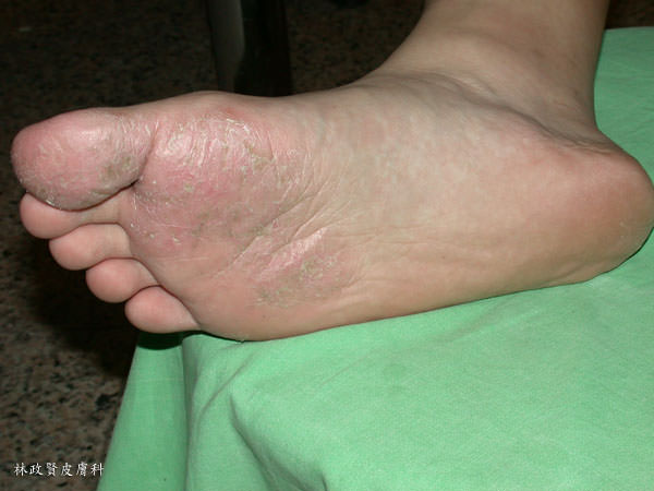 香港腳,足癬,青少年足底皮膚病,