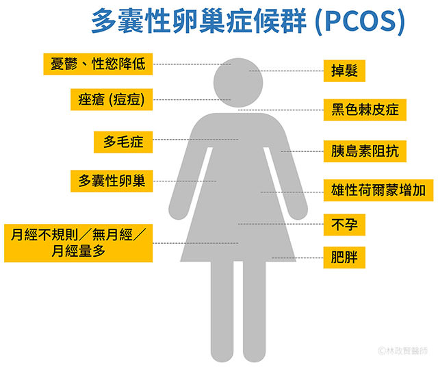 多囊性卵巢症候群,pcos,polycystic ovary syndrome