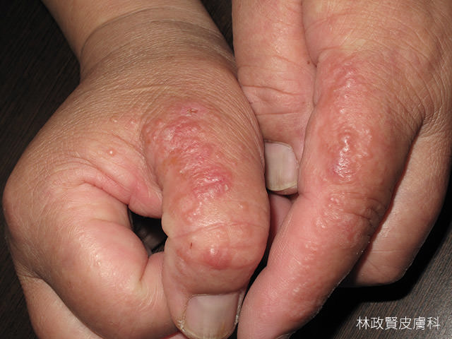 汗皰疹,汗疱疹,pompholyx,dyshidrotic eczema,手部濕疹