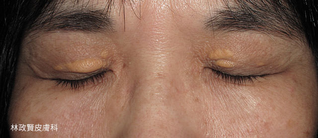 xanthelasma,眼瞼黃斑瘤,眼瞼黃色瘤,三氯醋酸,雷射,冷凍,手術