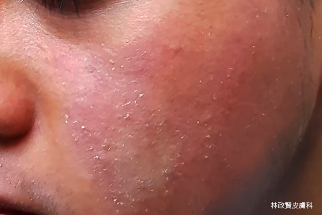異位性皮膚炎,atopic dermatitis