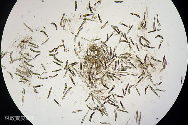 demodex,demodicosis,毛囊蠕形蟲症,顯微鏡