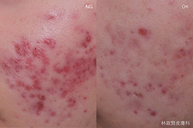 紅痘印的完整攻略:紅色痘疤需要治療嗎?哪種雷射最有效?有省錢便宜高CP值的方法嗎?