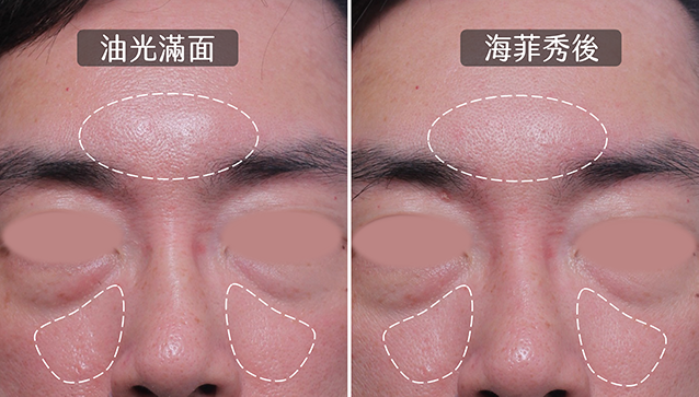 毛孔粗大,UP雷射,皮秒雷射,口服A酸,羅可坦,roaccutane,縮毛孔,縮小毛孔