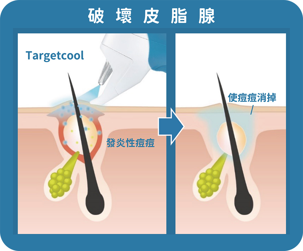 targetcool,疼就酷,養膚,育髮,痘痘,減痛