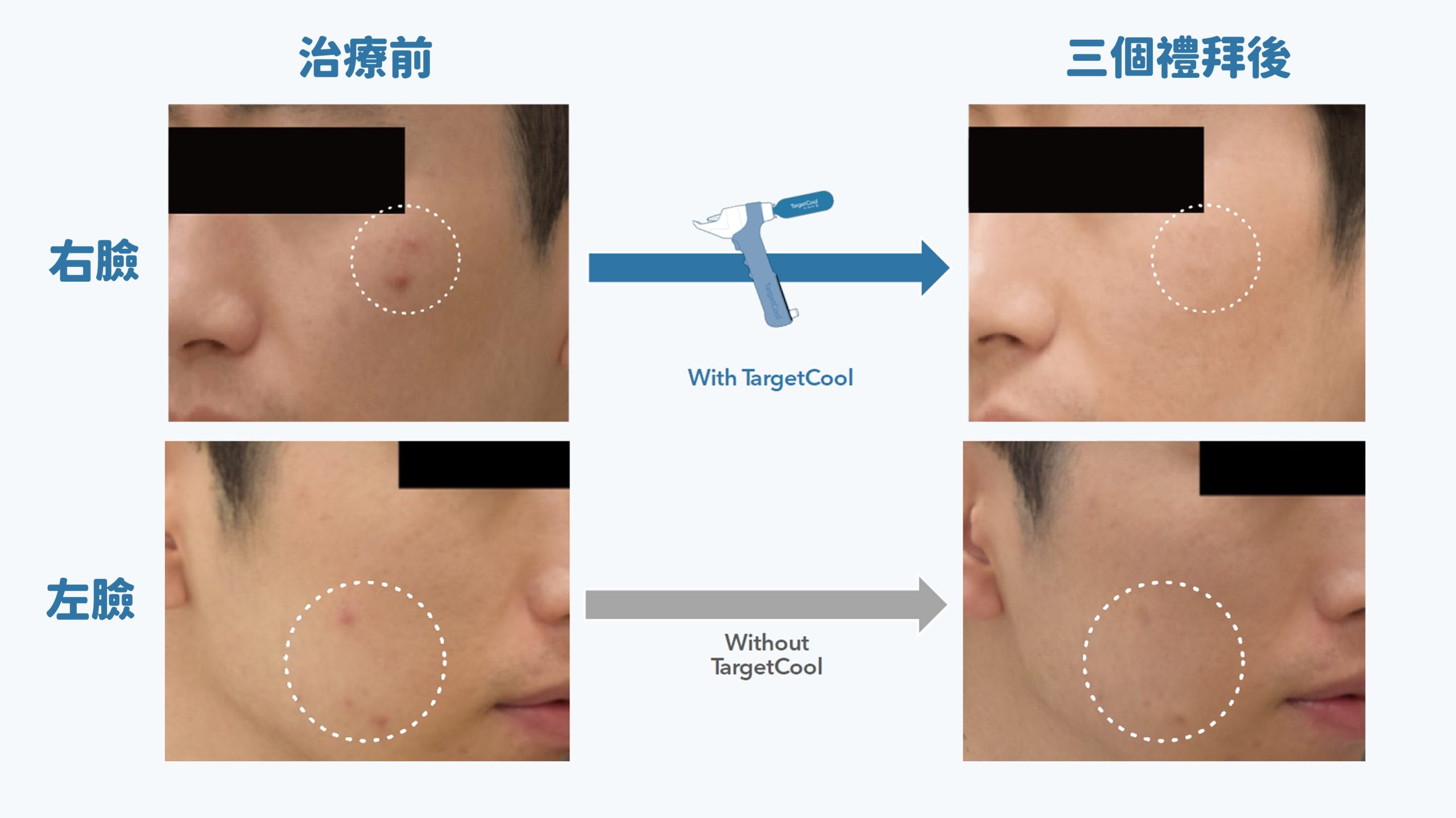 targetcool,疼就酷,養膚,育髮,痘痘,減痛